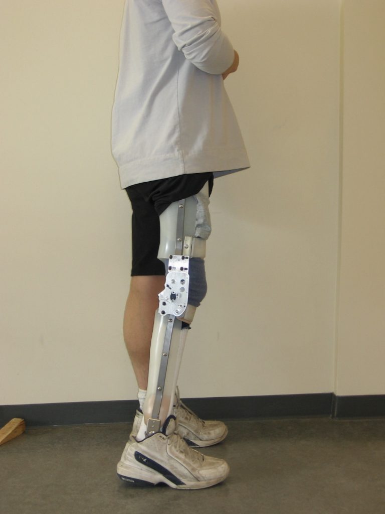 DEVELOPMENT AND EVALUATION OF A MECHANICAL STANCE-CONTROLLED ORTHOTIC KNEE JOINT WITH STANCE FLEXION